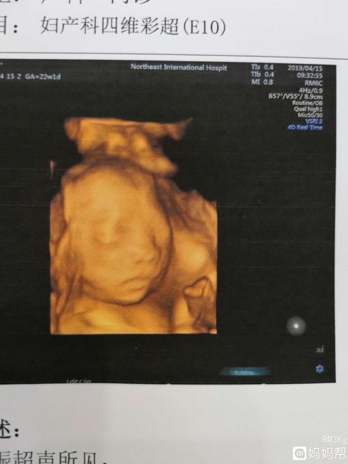 如果现在怀孕23周了,做彩超检查需要重点观察胎儿各方面的发育情况