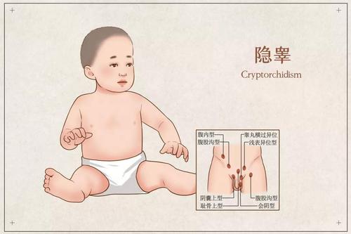 医生给小王做体格检查时发现他左侧阴囊内没有睾丸,追问病史,其实在
