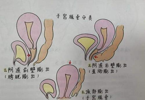 子宫脱垂的三种分类