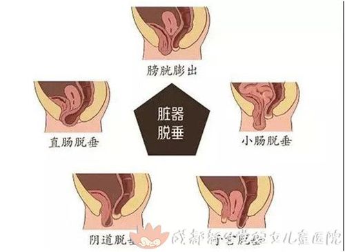 胎儿体重增加,妊娠腹腔压力增高,盆底肌受重力压迫,造成盆底肌肉松弛
