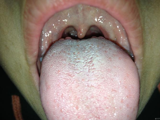 小儿舌根长些突起淡红色质地如鼻尖没有其他伴随症状考虑是什么