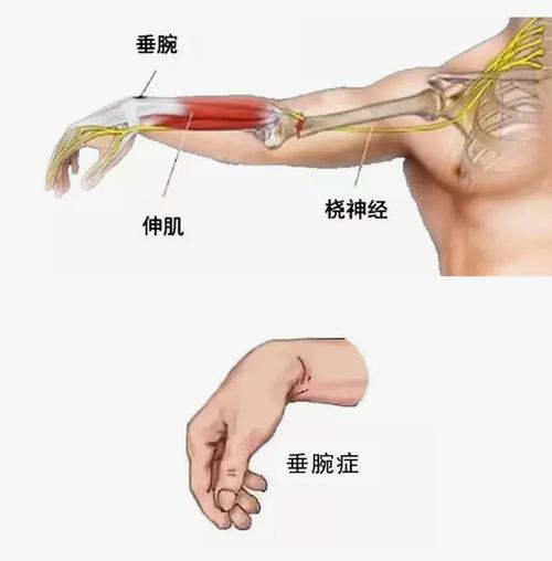 手臂长时间受到压迫,里面的桡神经可能就会受到损伤.