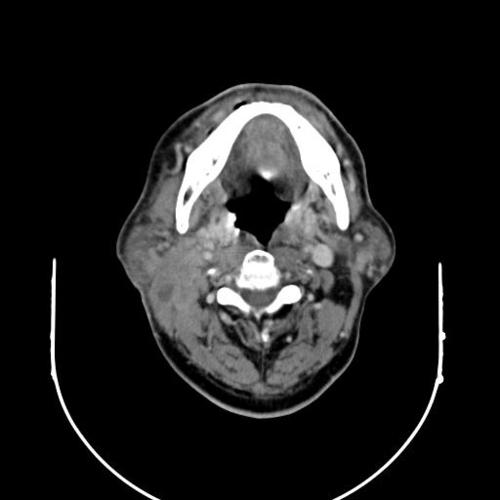 病例腮腺腺淋巴瘤1例影像表现