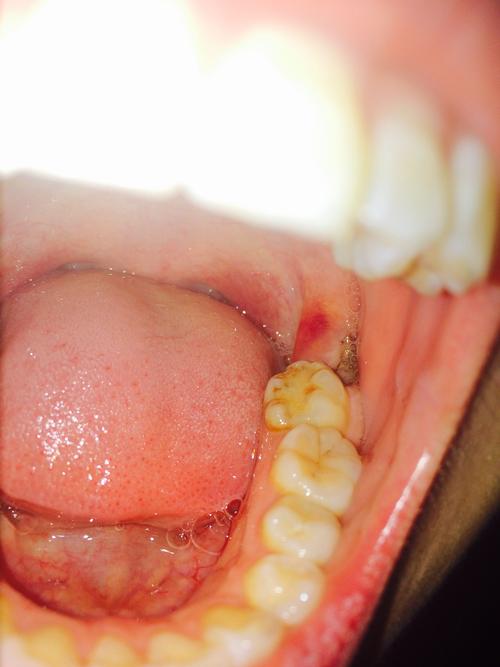 拔智齿三天后牙龈有一块成了紫红色怎么办,是怎么回事