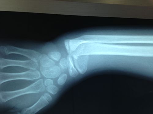 请大家看看张x光片,桡骨远端骨折复位前后