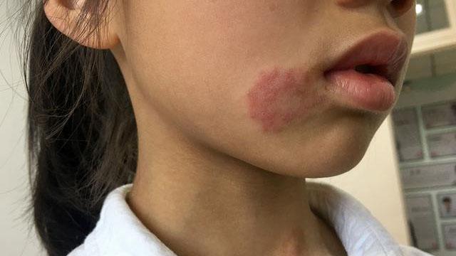 9岁女孩脸上出现红疹却误被当做湿疹治疗