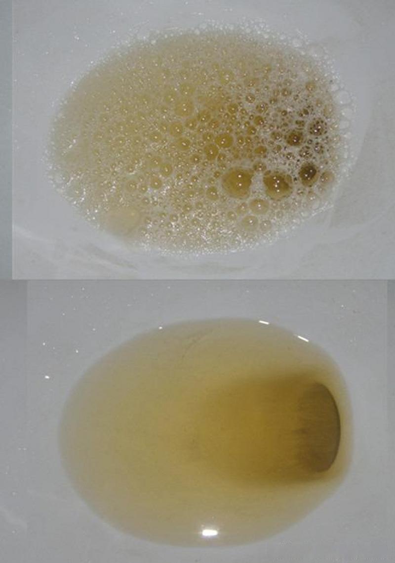 泡沫尿知识!我们都知道正常尿液为透明,琥珀色的液体,颜色有深有淡.