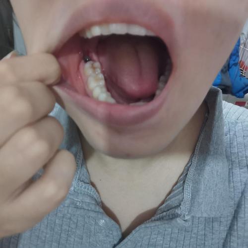 拔牙之后巨大牙洞干燥症