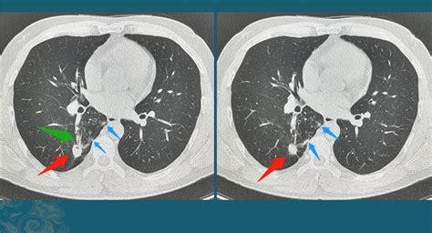 肺部点状钙化影