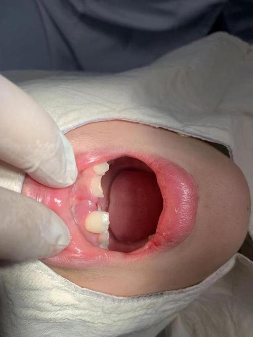 看着孩子在长沙市第三医院口腔科顺利拔除了隐藏在两颗门牙间的多生牙