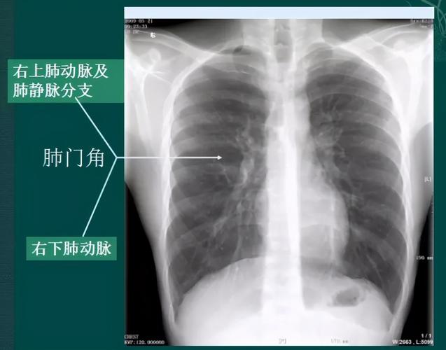 门的外缘;右肺门下部约占2/3,由右下肺动脉干构成,其正常宽度不超过15