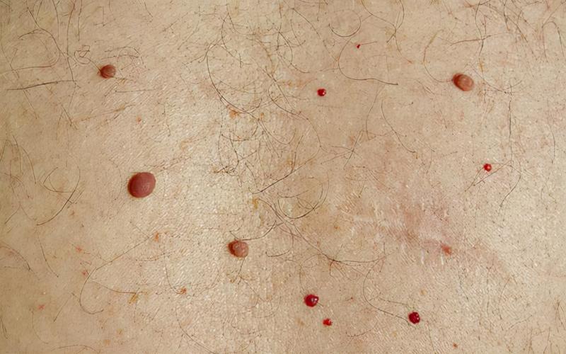 资深紫癜专家表示,皮下出血是一种比较常见的病症,是皮下毛细血管破裂