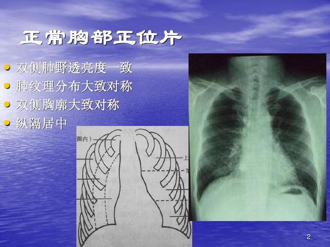 正常胸部正位片         双侧肺野透亮度一致 肺纹理分布大致对称