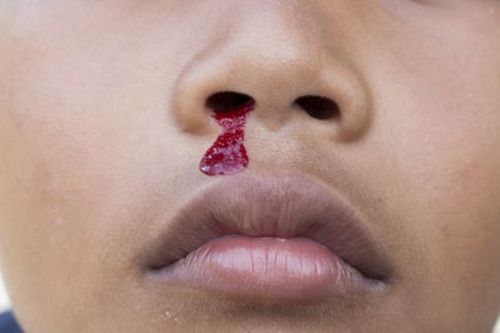 儿童鼻出血的护理 有哪些预防措施