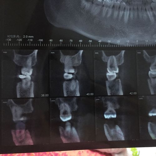 这是我的牙齿x光射线片子,吃饭咀嚼就疼,目前在吃消炎药,有一颗牙补过
