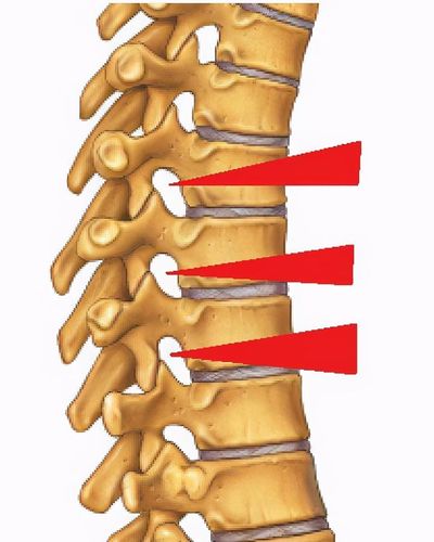 红色指的就是椎间孔根据压迫的神经不同,手部麻,痛位置也不同.
