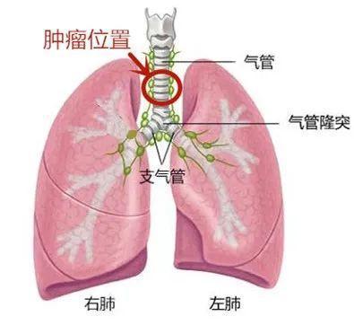 每一个肺癌患者都要知道呼吸内镜关键时刻能救命