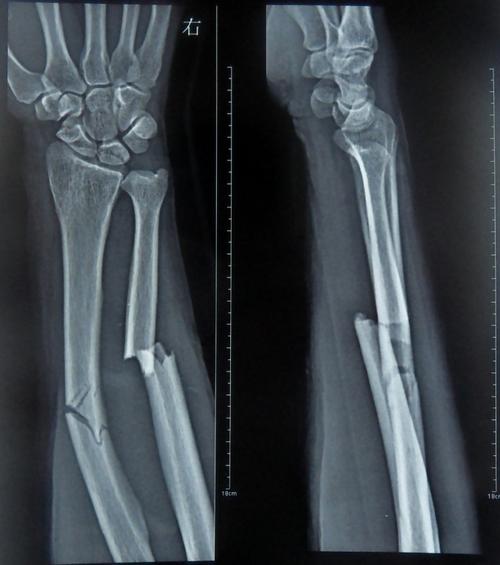 展开全部 尺桡骨双骨折是指尺骨干和桡骨干同时发生的骨折.