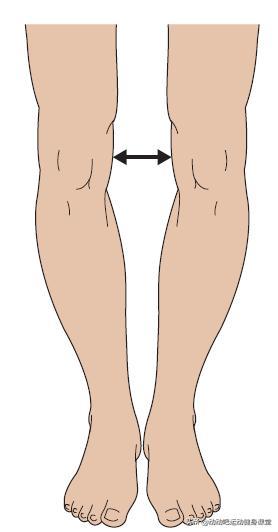 (o型腿)(x型腿)观察髌骨是否外旋或内旋,外旋则