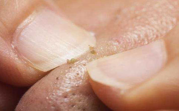 就是皮肤新陈代谢分泌的油脂在毛孔里堆积硬化,凝结形成的油脂角栓