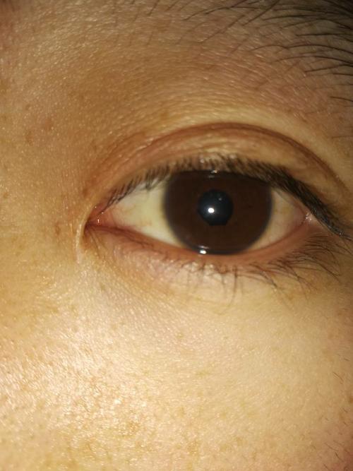 眼科#我这个瞳孔外伤性散大,但是今天发现边缘左下角不圆,这是巩膜