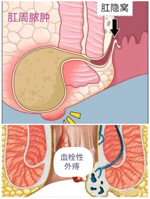 肛门长出"嘉宝果"~漳州市第二医院肛肠科王素妹医生谈血栓性外痔的