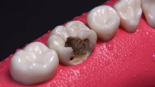 一颗被蛀虫吃空的牙齿是如何在医生的操作下恢复如初?