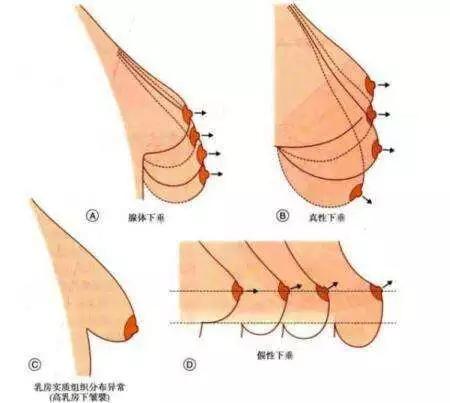 乳腺组织的多少,乳房是否对称,胸廓形态,乳房的松弛程度都对假体丰胸