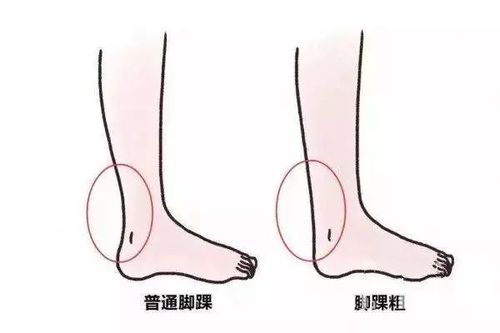 很少有人注意到脚踝部位的粗细,若脚踝部位长期水肿,身体的其他部位