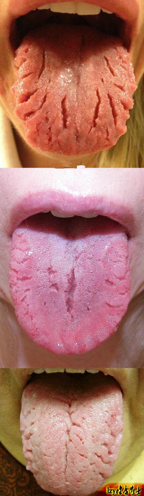 裂纹舌的中医治疗 (转载)