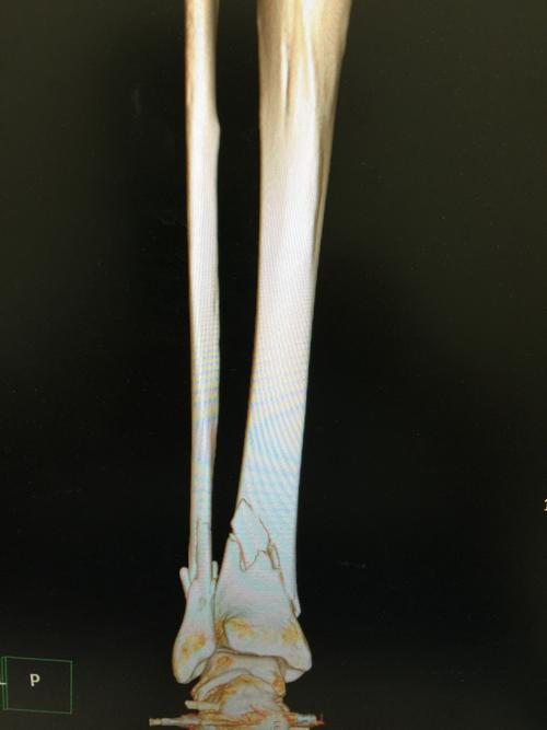 左胫腓骨粉碎性骨折