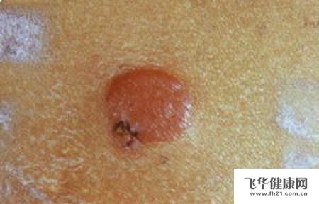 治疗原发性皮肤滤泡中心细胞性淋巴瘤的方法