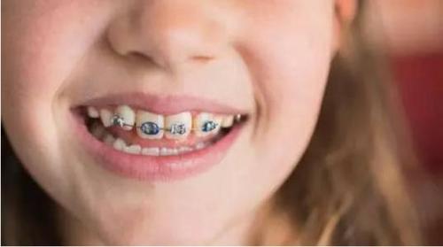 张家港那有做儿童矫正的医院吗-儿童正畸-牙博士口腔品牌连锁