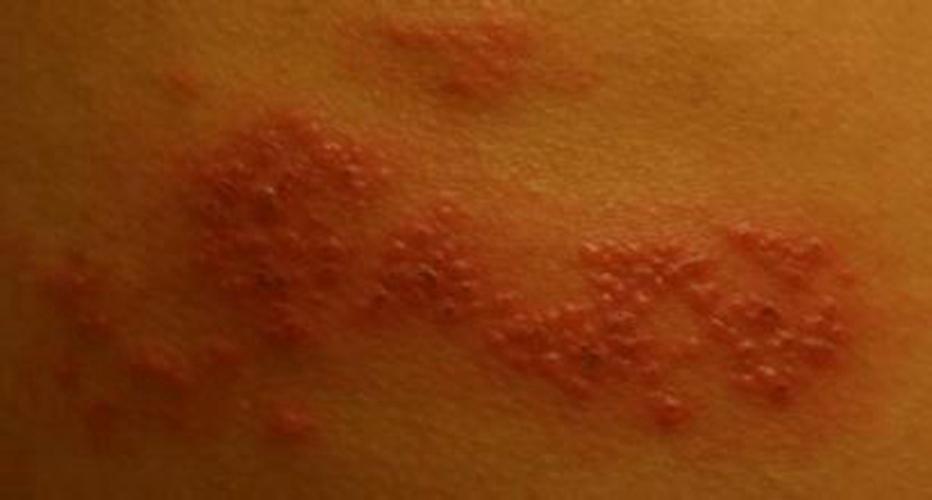 梅毒感染发病初期的症状特征图片