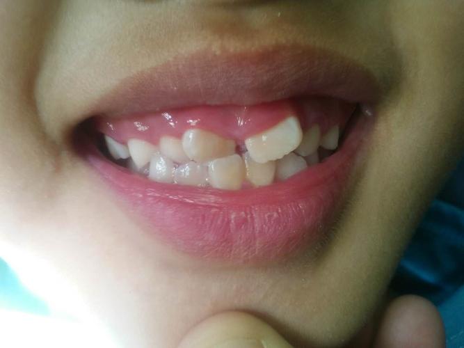 儿童的早期矫治门牙的间隙和反合