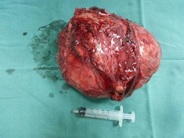 泌尿外科成功实施腹腔镜肾上腺巨大嗜铬细胞瘤切除术 - 好大夫在线
