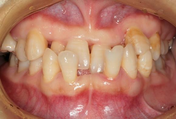 重度牙周炎前牙反合矫正(图)