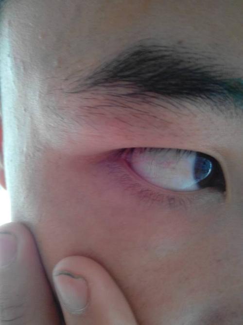 问:我右眼的右眼角发炎 嘀眼药水也不管用 有的时候右眼视力会变模糊