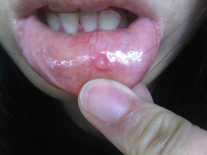 半个月前下嘴唇长了颗豆大的水泡,咬破后出血 无疼痛 瘙痒等症状,并且