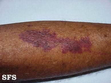 发生紫癜;血液病,结缔组织疾病,糖尿病及癌症等慢性消耗性疾病的患者