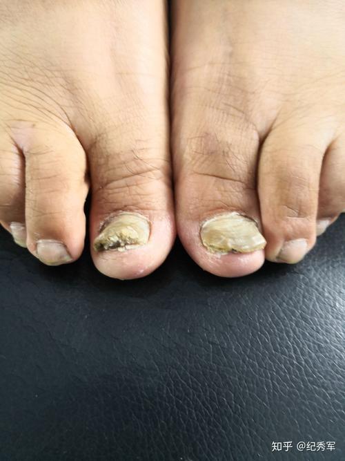 灰指甲/甲癣是真菌感染引起的传染性皮肤病,需要使用药物口服涂擦治疗