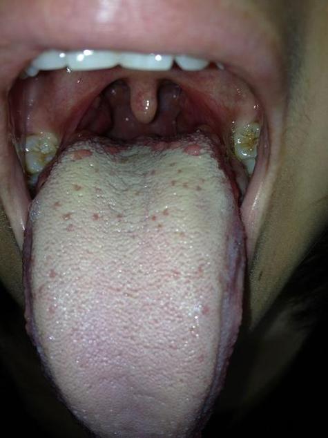舌头上长泡是什么原因