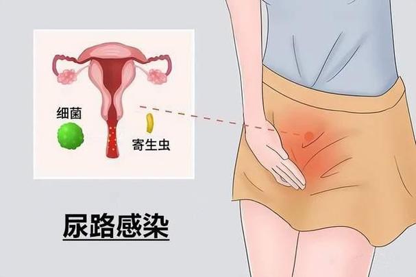 每年一到天热时节,泌尿系感染就易高发,很多女性会出现尿频,尿急,尿痛