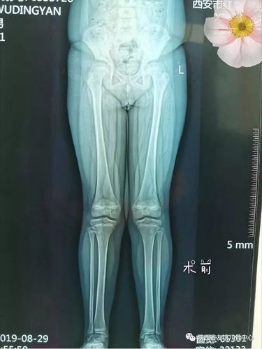 11岁男孩膝外翻双下肢单侧骨骺阻止手术