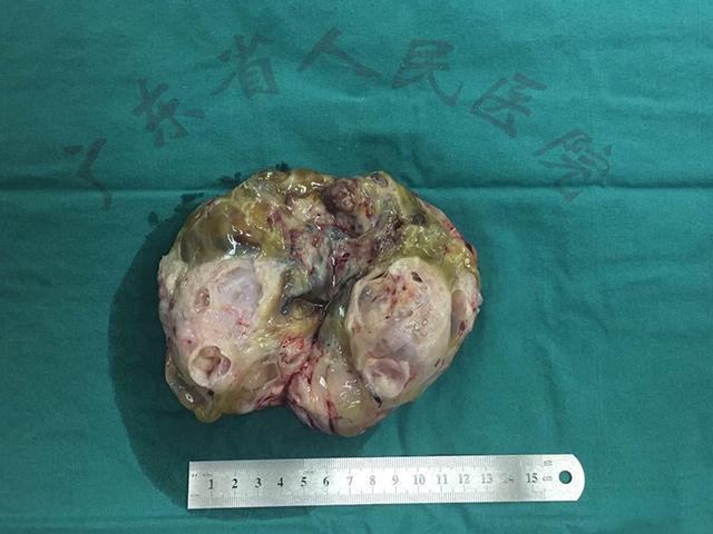 宝宝良性颅内畸胎瘤是怎么形成的