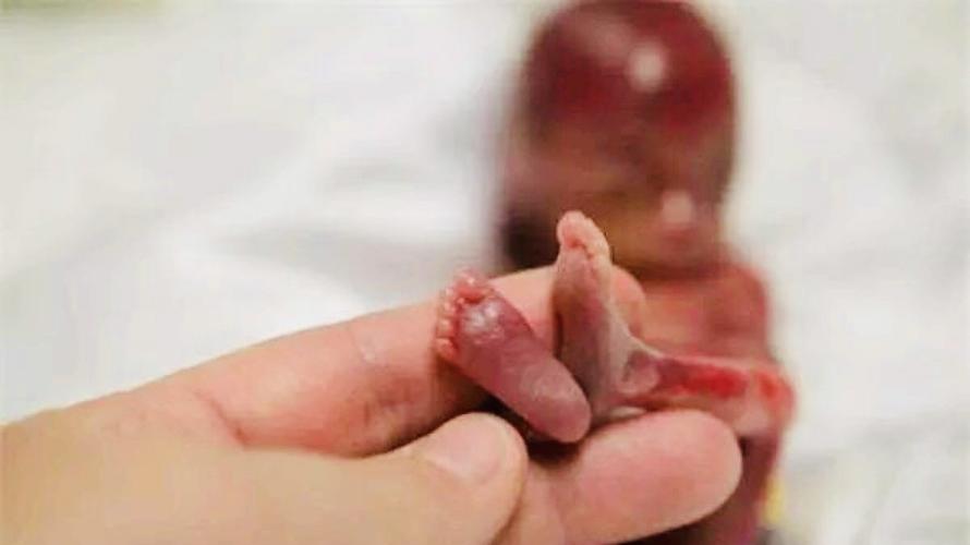 山西省儿童医院妇幼保健院nicu成功救治胎龄23周宝宝,再创生命奇迹