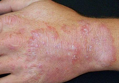 真菌感染皮肤病图片的种类及症状