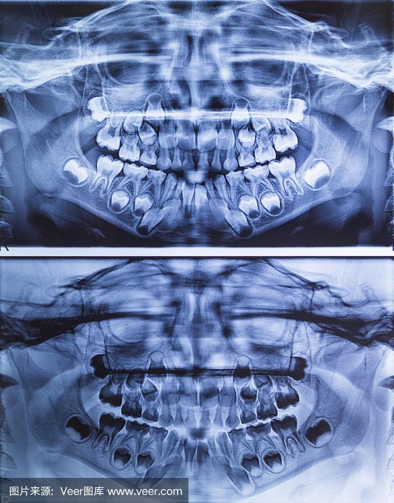 儿童牙科x光全景图
