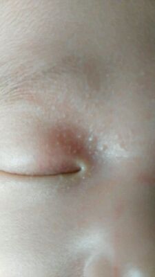 宝妈们,能不能帮我看看宝宝眼睛上的痘痘是怎麼回事?