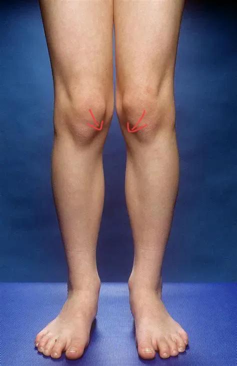 内旋型x型腿还因重心朝踝关节内侧脚踝偏移,导致脚底朝外翻容易足弓